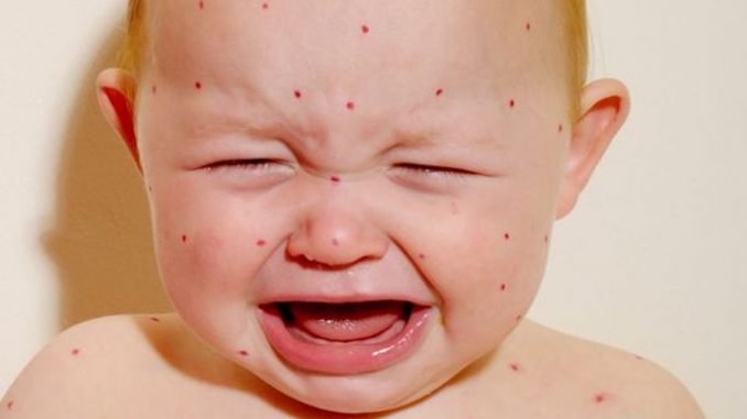 Measles outbreaks are caused by vaccinated children passing the virus on to unvaccinated children, says Dr. Suzanne Humphries.