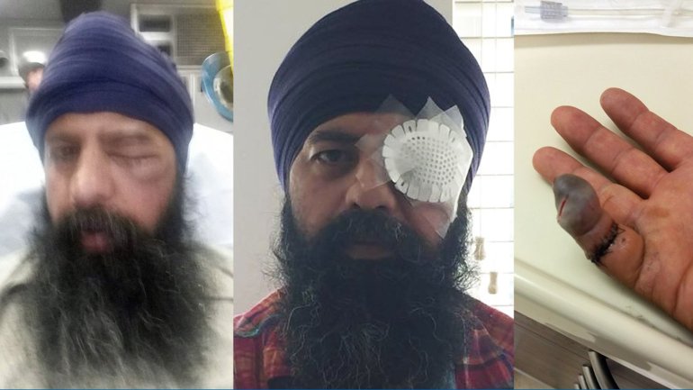 The Sikh Coalition released these images of Maan Singh Khalsa who was brutally beaten in Richmond on Sept. 25, 2016.