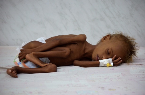 Yemen collapse Cholera