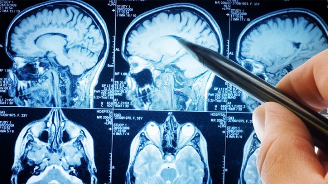 Neuroscientist reveal that fasting can cure many different types of diseases