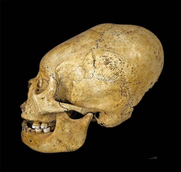 Proto Nazca deformed skull, c 200–100 BC. (CC BY-SA 4.0)