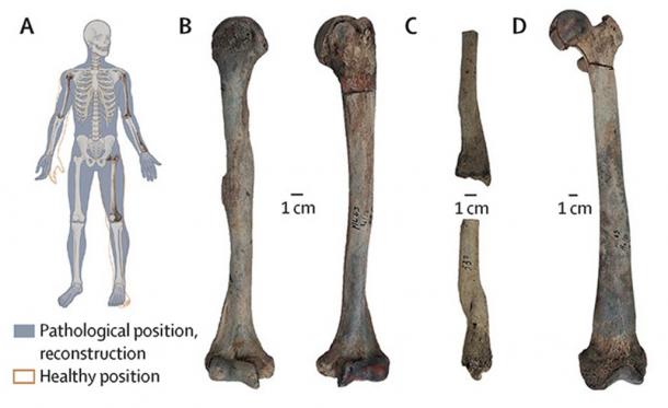 Paleontologists analyzing the remains of a Neolithic man unearthed in Maliq, Albania, have discovered that he suffered from a condition known as osteopetrosis, also known as stone bone disease. (Gresky et al. / The Lancet Diabetes and Endocrinology)
