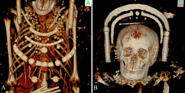The female mummies were wearing beautiful necklaces. A volume rendered reconstruction showing the details of the young female portrait mummy with beads around the neck, the thoracic region and a hairpin on top of her head. (Zesch S, et al. PLOS One / CC BY 4.0)