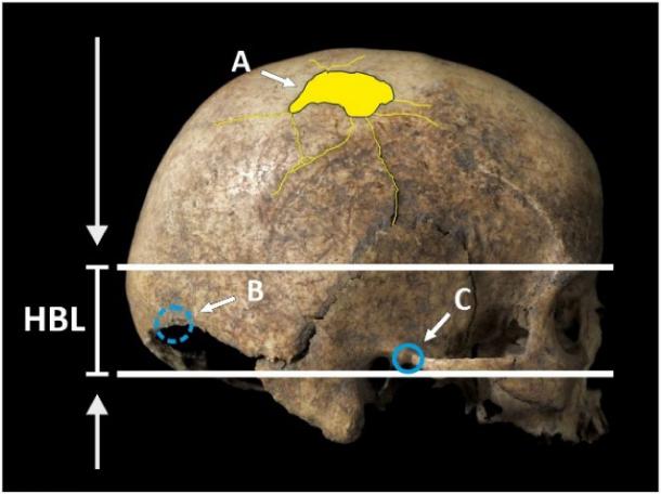 Location of cranial trauma on the Cova Foradada skull with respect to the hat brim line: (A) perimortem parietal fracture; (B) antemortem occipital fracture, on the opposite side; and (C) antemortem temporal lesion. (International Journal of Paleopathology)