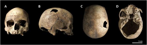 The Cova Foradada skull as viewed from different angles. (Image: International Journal of Paleopathology)