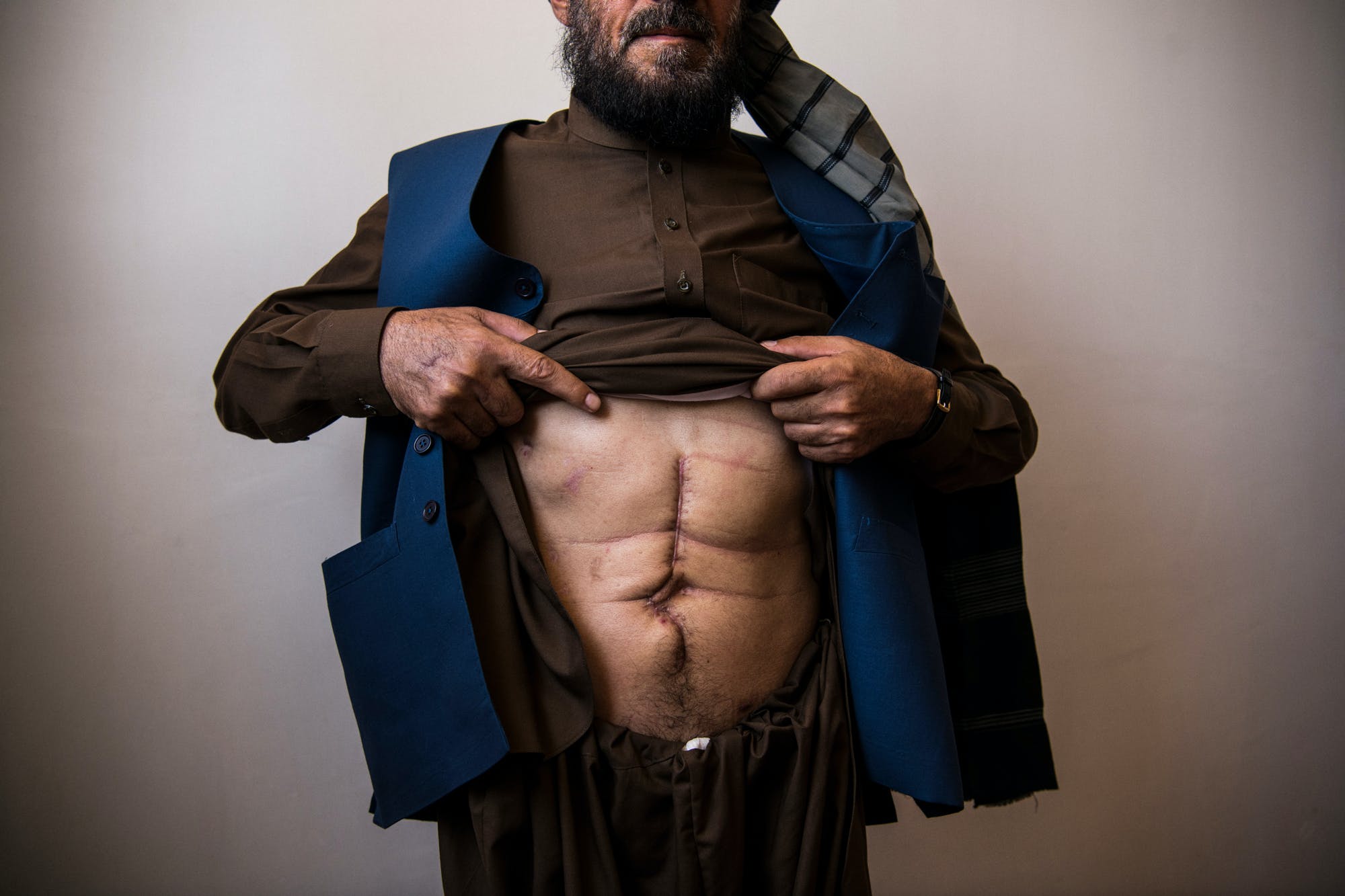 Ahmad Jamal, 56, shows scars from shrapnel wounds and subsequent surgeries from American air strikes on his family home in Sher Toghi on the night of March 2 and the morning of March 3, 2019. Ahmad Jamal lost his wife and three of his seven children in the attack. He and several surviving children were flown to an NDS hospital in Kabul, where he says they were given rudimentary medical care, refused pain medication, and chained to beds. Three days later, they were dumped by the side of the road near the Kabul Intercontinental Hotel.