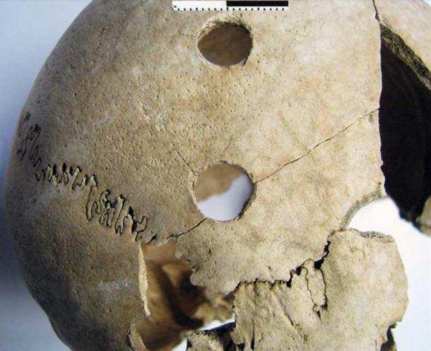 Penetrating injuries on the right side of the skull of a young adult female from the Potočani massacre. (Prof. Mario Novak / Institute for Anthropological Research)