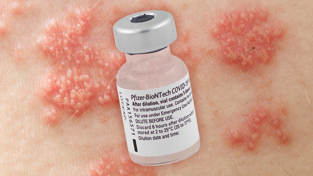 A vial of the Pfizer/BioNTech mRNA vaccine over a close up of skin with shingles