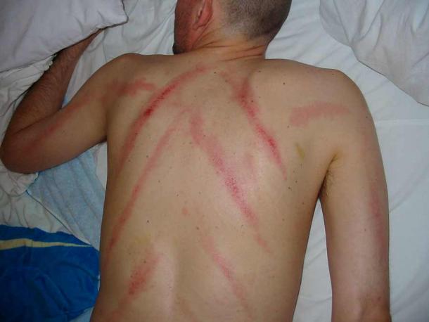 A patient after a Gua Sha back treatment. (Jugana / CC BY-SA 3.0)