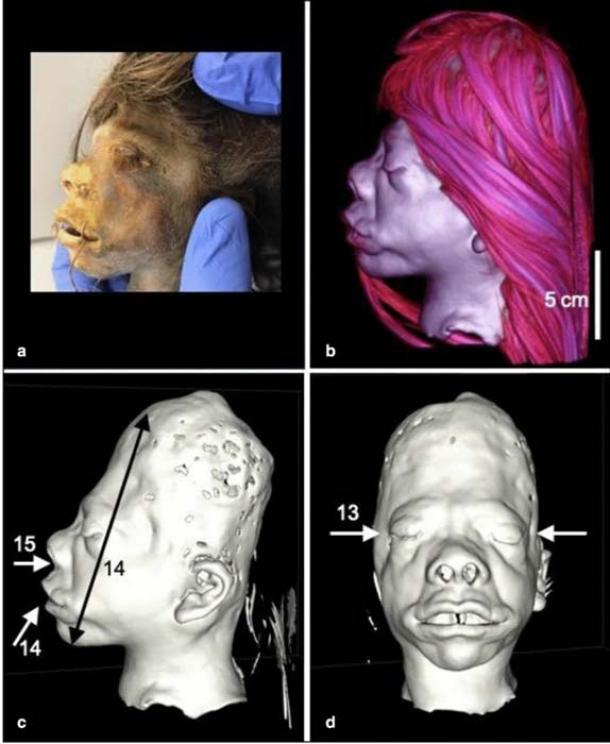 Key anatomical features of the tsantsa of probable Ecuadorian origin. a) Profile of tsantsa with hair lifted off side of face. b) 3D volume rendering of tsantsa CT scan. c and d) Surface renderings of tsantsa CT scan. Virtual removal of the tsantsa’s hair revealed an elongated profile. Visible artifacts of handling during preparation and preservation include extension of the mouth, distended lips and superiorly turned nostrils. Also evident are distinct depressions at the temples. (Heritage Science)