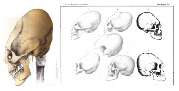Elongated Skull from Crimea and other parts of the worlds, Baer 1860