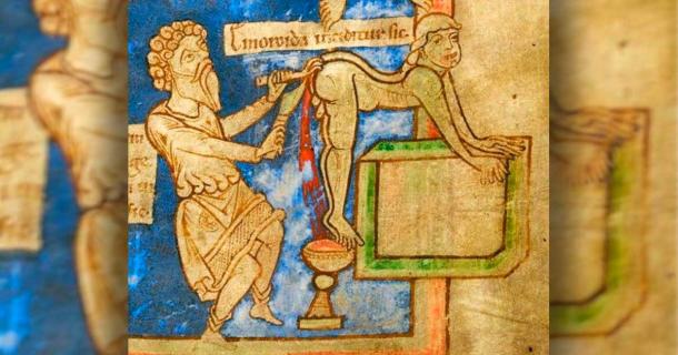 13th century depiction of hemorrhoid surgery. Source: The British Library / Public Domain