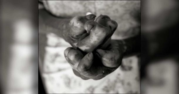 The hands of a person with leprosy. Source: paul salmon/EyeEm / Adobe Stock