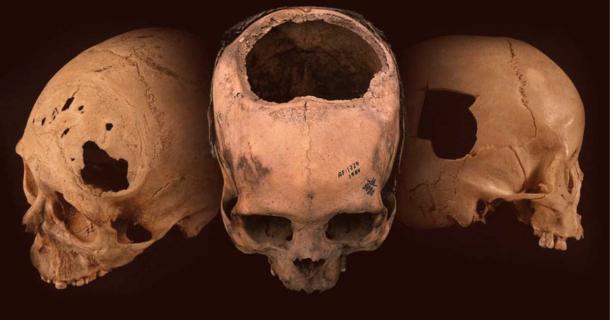 Trepanned skulls have been found worldwide, from Siberia to Turkey to Peru. Pictured: Peruvian trepanation patients. Source: University of Miami